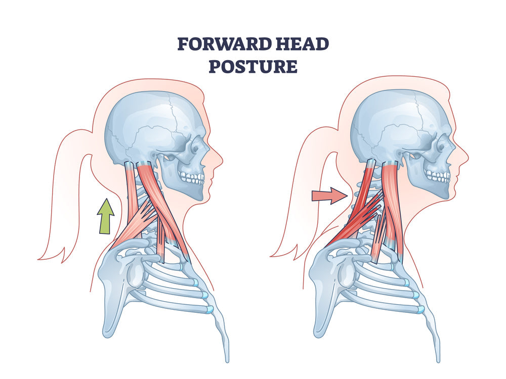 How to Fix Forward Head Posture at Home