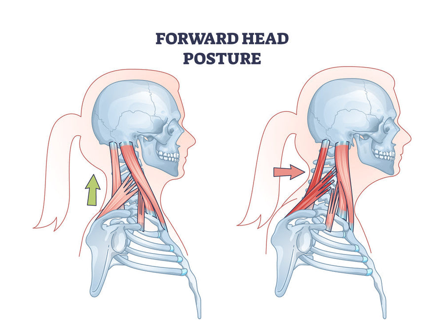 How to Fix Forward Head Posture at Home